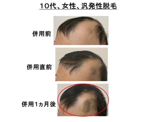 円形脱毛症　病院